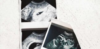 Ultrasound photo prints on a light surface